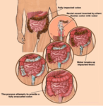 Regenerarea intestinelor in centrul Infrafit